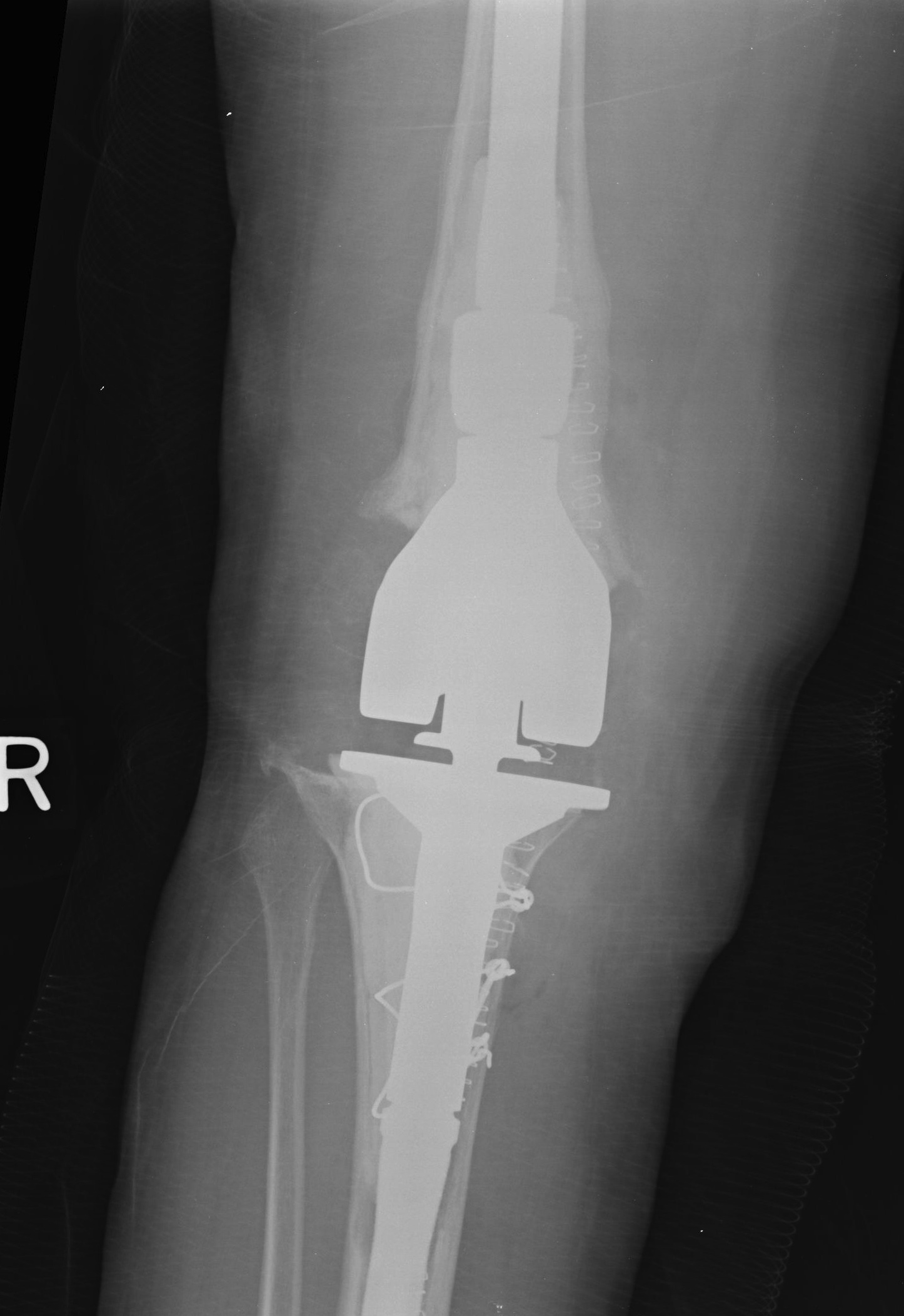 Revision TKR Tumour 